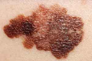 Australia scientists develop world first melanoma blood test