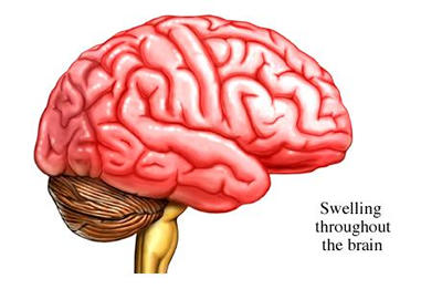 Encephalitis Strikes again in Bengal