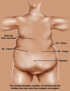 Bariatric surgeries up ten times in last decade: OSSI