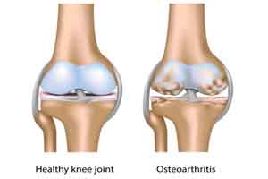 Common mental health drug found to treat osteoarthritis