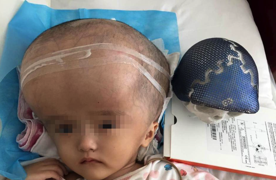 A 20 kg skull of a Chinese toddler replaced by 3D-printed skull