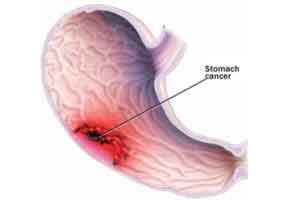 Antibiotics shots for ulcers may reduce the risk of developing stomach cancer