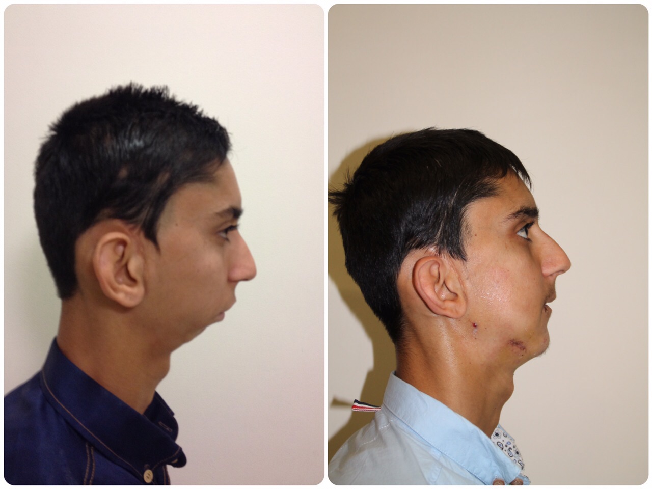 Fortis Gurgaon surgeons repair fused jaw bones of a 21-year old