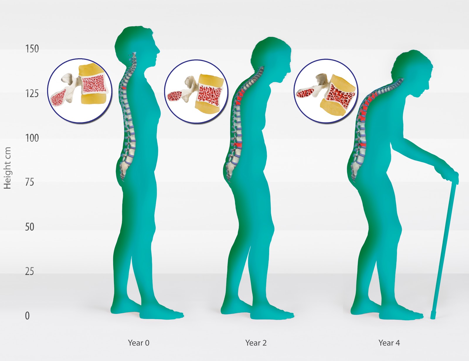 Aurobindo Pharma gets USFDA nod for generic osteoporosis drug