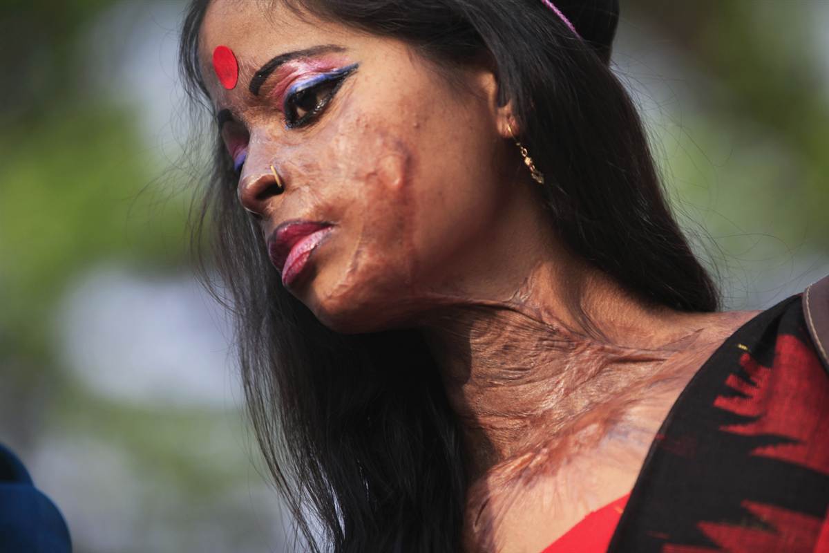 Acid attack victims entitled to free treatments in private hospitals in Delhi