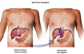 Liver transplant camp in Pakistan with an Indian hospital conducted