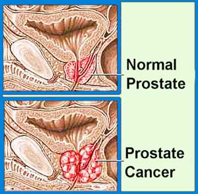 Cuba in third stage trial process for advanced prostate cancer vaccine