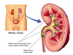 Urinary tract infection detected in an hour by a new device