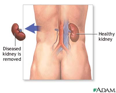 Kidney removal at AIIMS: HoD seeks case details