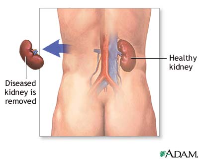 New way to destroy kidney cancer cells in the making