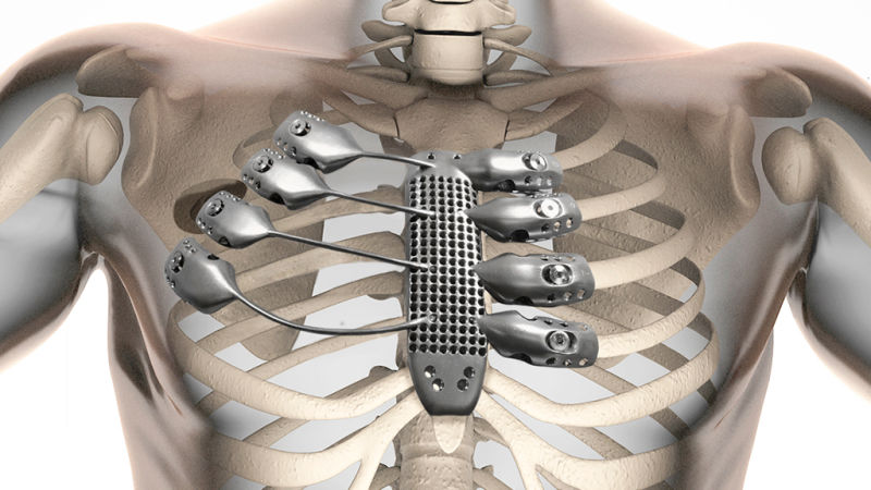 First 3D rib implant for a Spanish cancer patient