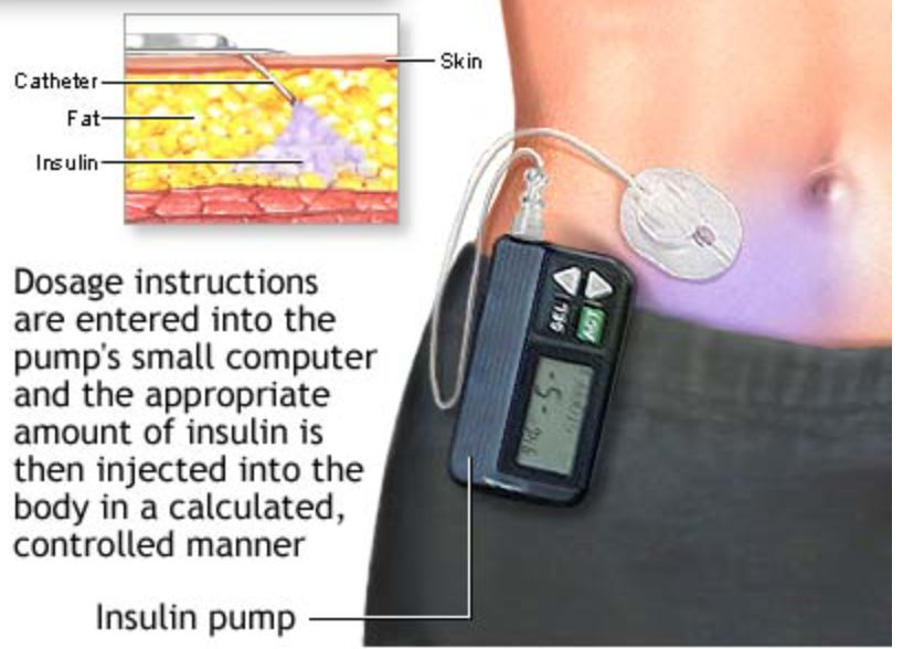 Insulin pumps safe for five years, says a new study