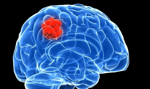 Scientists discover new genes associated with brain cancer