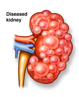 Sedentary lifestyle can lead to kidney disease