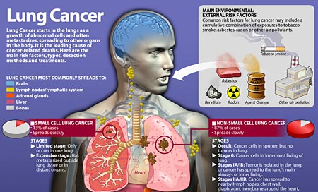 FDA approves new oral therapy to treat ALK-positive lung cancer