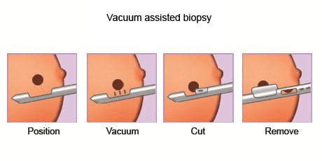 Vacuum Assisted Breast Biopsy introduced to treat breast cancer