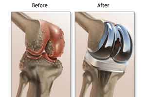 AIIMS doctors conduct BCS knee replacement surgery
