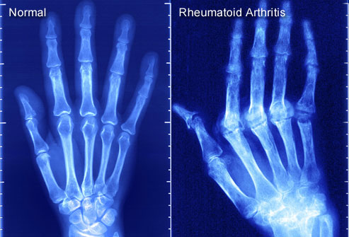 London: Simple blood test could detect arthritis 16 years in advance