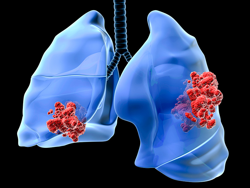 FDA approves Genentech drug for advanced lung cancer