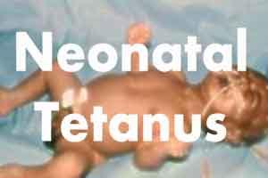 PGIMER confirms diagnosis of neonatal tetanus in infant