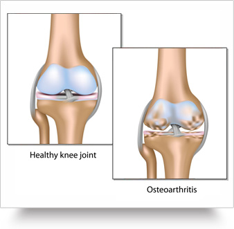 Kitov Pharmas arthritis drug meets main goal in late-stage study