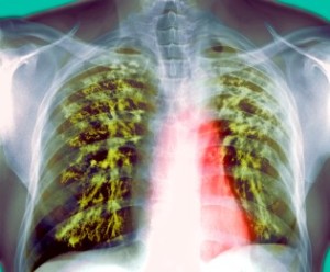 TB Deaths down by 19 percent from 2010-2018: Union Health Minister