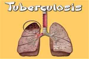 Tuberculosis can be eradicated by 2045: Experts