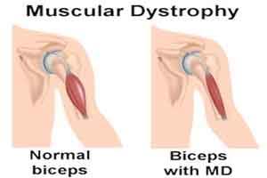 UP: Muscular Dystrophy patients stage hunger strike seeking Centres assistance for treatment