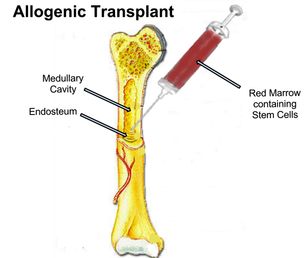 Nagpur: Children requiring bone marrow transplant to get financial aid from govt