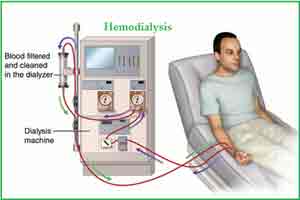 Dialysis unit at district central hospital in Chittoor to start functioning