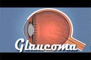 Researchers discover three glaucoma related genes