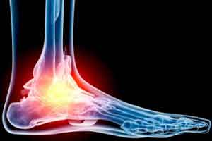 500 orthopaedics discuss tackling ankle-foot injuries