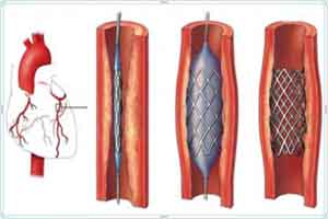 No surgery under Japanese method to remove arteries blockage