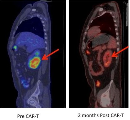 Positron emission tomography (PET) images showing large tumor mass in the kidney prior to therapy that completely regressed on a repeat PET scan performed two months after. (Fred Hutch News Service)