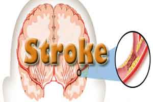 WHO urges SE Asian countries to strengthen vigilance against stroke