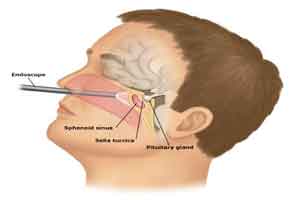 Mumbai: Doctors at Fortis remove pituitary tumours with Scarless Endoscopic Transsphenoidal Surgery