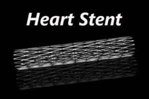 High Court notice to MCI, CSI, Health Ministry on Alleged practice of Unnecessary Stenting