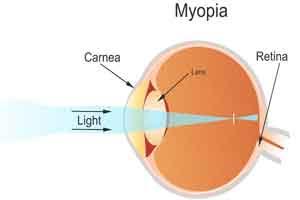 Lifestyle changes a factor for myopia among children: Nadda