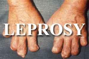 WHO aims for zero leprosy by 2020