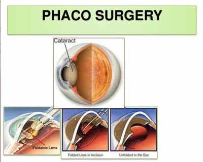 Government mulling conducting all eye operations through phaco surgery