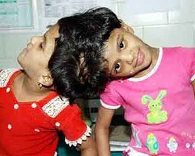 Surgical separation of conjoined twins-high risk