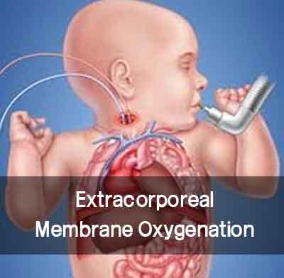 Telangana: Neonatal ECMO performed at KIMS Hospitals