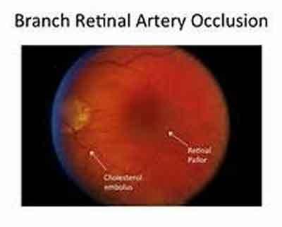 Delhi : 20 yr old Boy suffering from Branch Retinal Artery Occlusion cured