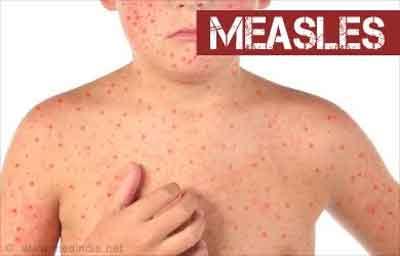 800 million dollar required to eliminate measles by 2020 from India, south east Asia: WHO