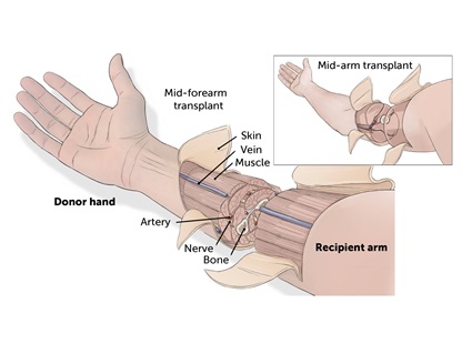 Global Hospitals receives license for hand transplantation