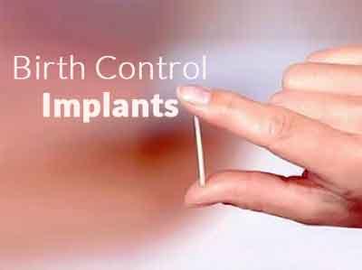 Image result for implant birth control