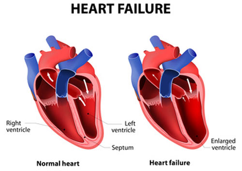 Support group for heart failure patients launched