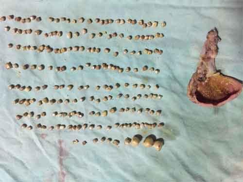 Sureons at Sassoon General Hospital remove 206 gall stones from a patient