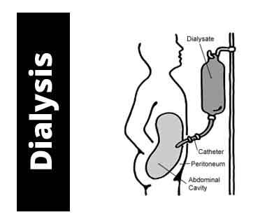 SDMC panel nod for dialysis at CGHS rates at six health centres