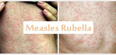 1.4 lakh patients died from measles worldwide in 2018: WHO